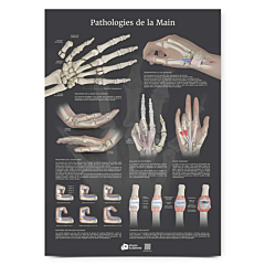 Planche plexiglass Pathologie de la main