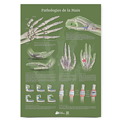 Planche anatomique Pathologies de la main