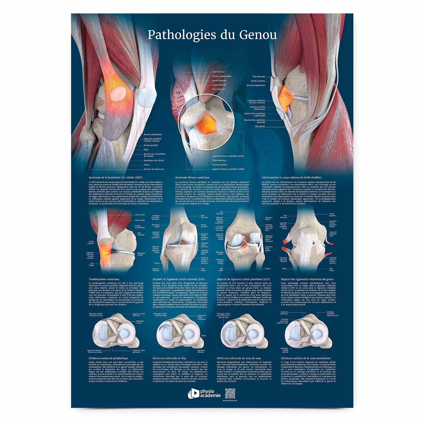 Poster Planche anatomique Pathologies du Genou 