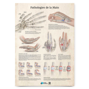 Poster Planche anatomique Pathologies de la Main