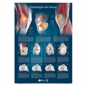 Poster Planche anatomique Pathologies du Genou 