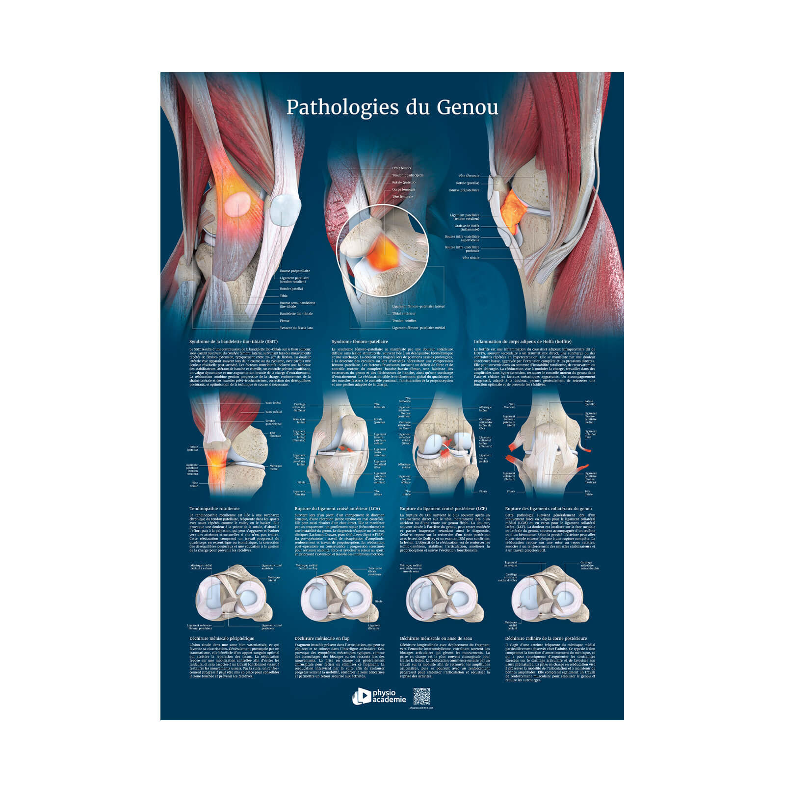 Pathologies du genou - Planche PVC 50 x 70 cm - Bleu