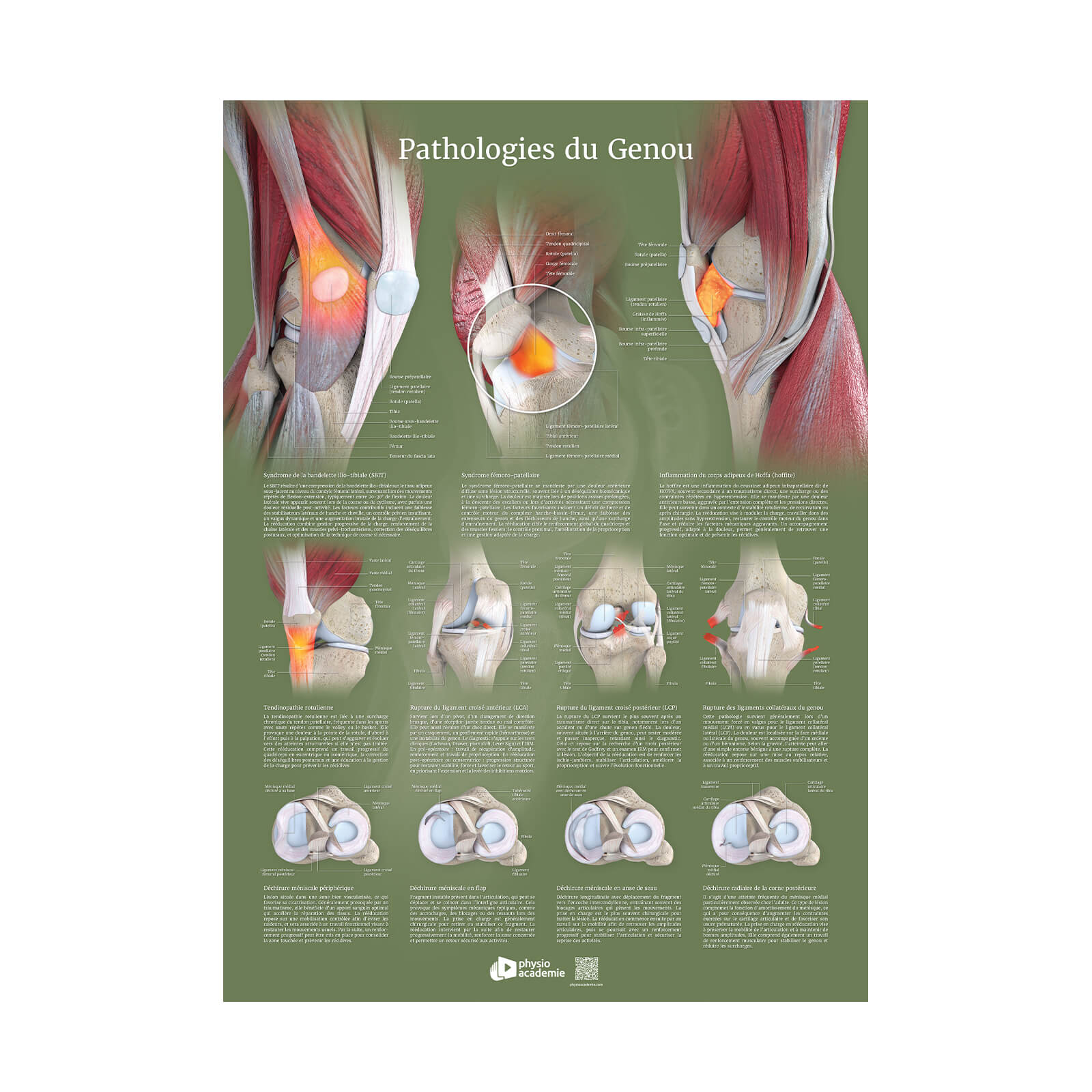 Pathologies du genou - Planche PVC 50 x 70 cm - Vert