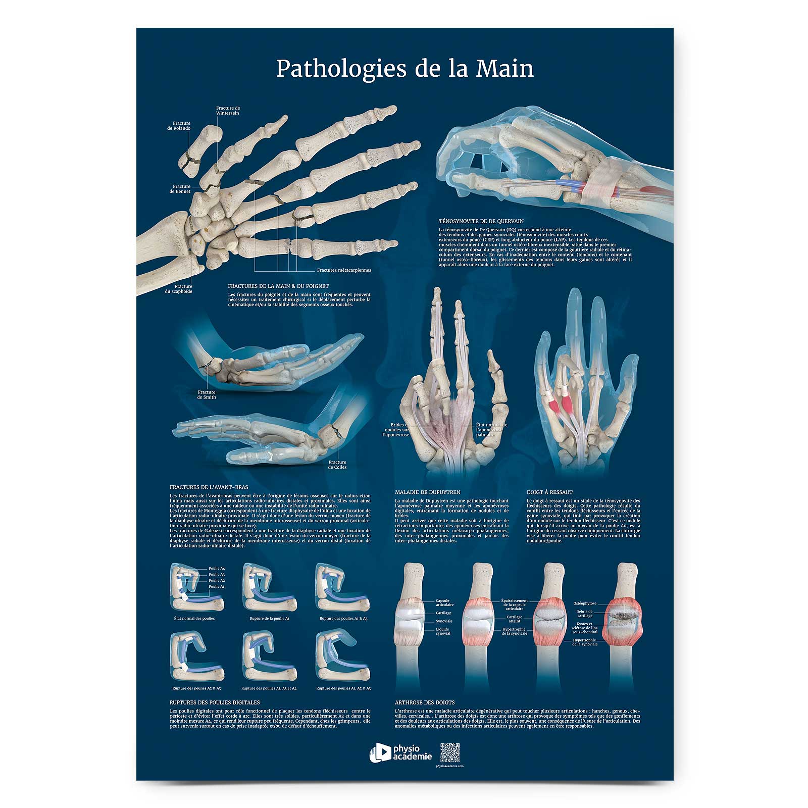 Pathologies de la Main - Planche PVC 50 x 70 cm - Bleu