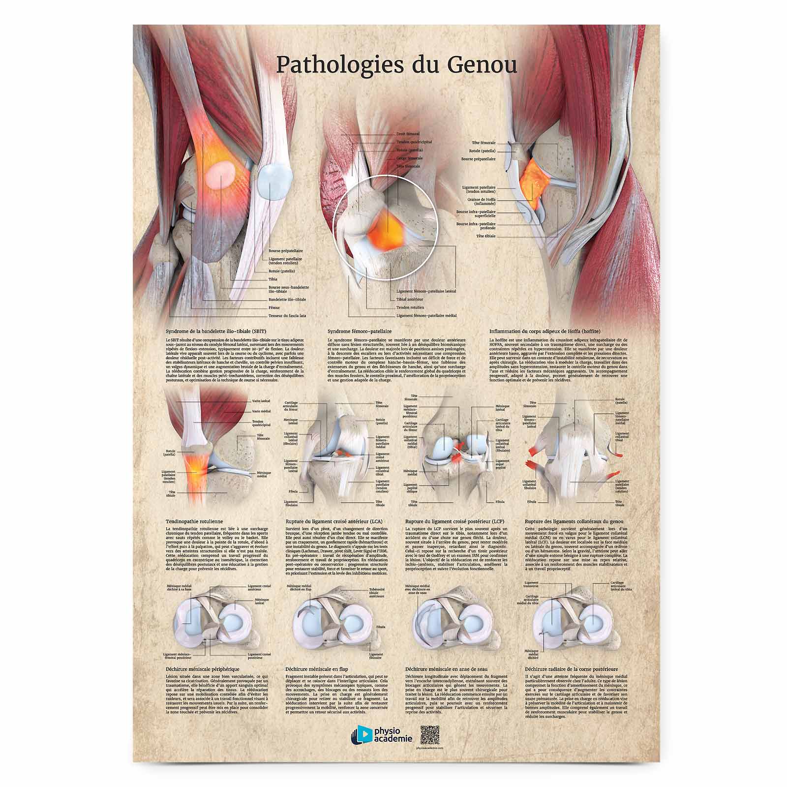 Pathologies du genou - Planche PVC 50 x 70 cm - Beige