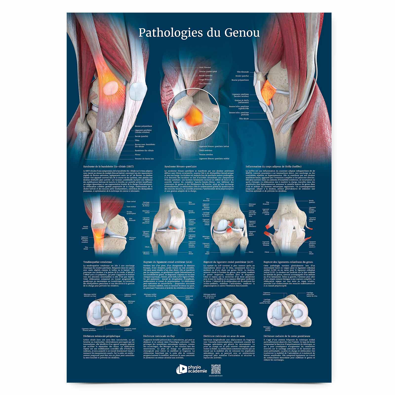 Pathologies du genou - Planche PVC 50 x 70 cm - Bleu