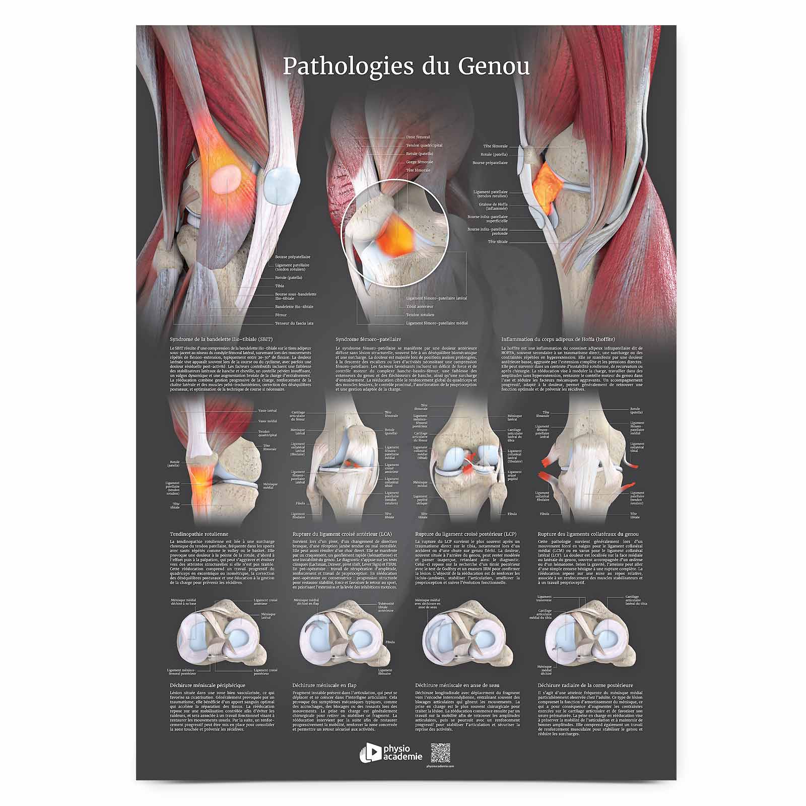 Pathologies du genou - Planche PVC 50 x 70 cm - Gris anthracite