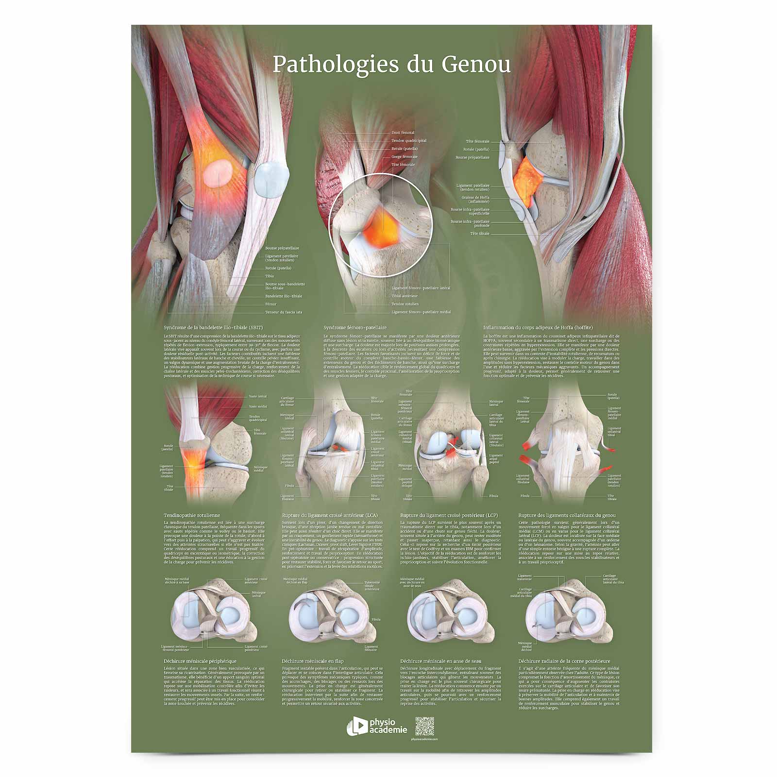 Pathologies du genou - Planche PVC 50 x 70 cm - Vert